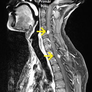 Abtropfmetastase Glioblastom und cervikaler Bandscheibenvorfall MRT-T1W mit KM