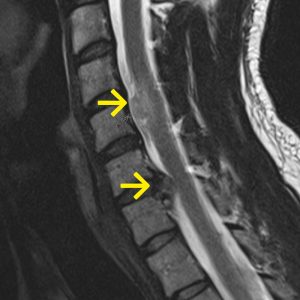 Abtropfmetastase Glioblastom Myeloninf und BSV sagT2-2mm