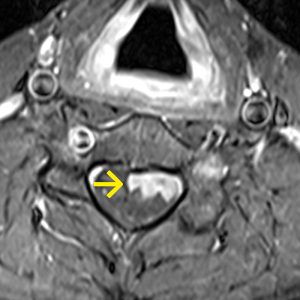 Abtropfmetastase Glioblastom axT1KM
