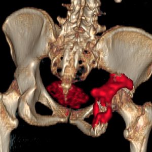 Acetabulummetastase links Schilddrüsenkarzinom FDG-PET/CT