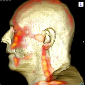 Aktivierte Arthrose Kiefergelenk Fluorid-PET/CT