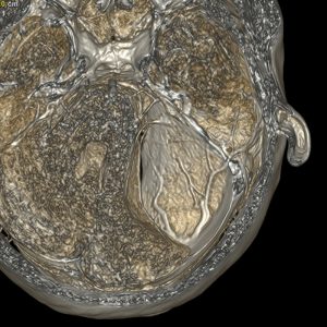 Arachnoidalzyste des Kleinhirnbrückenwinkels MRT-T2W-Dünnschicht-VR