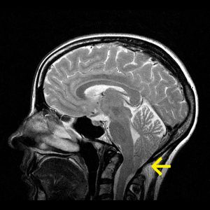 Arnold-Chiari-Malformation Typ I