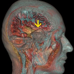 Astrozytomrezidiv Temprallappenepilepsie MRT-VR