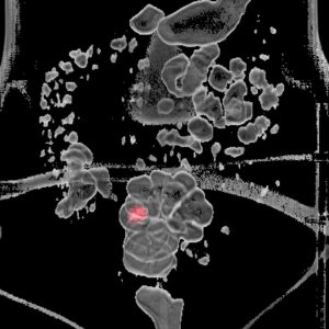 Atypischer Sigmapolyp FDG-PET/CT mit virtueller Colonographie Atypischer Sigmapolyp FDG-PET/CT mit virtueller Colonographie