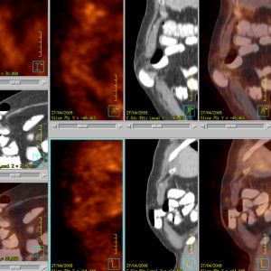 Bauchdeckenhernie FDG-PET/CT
