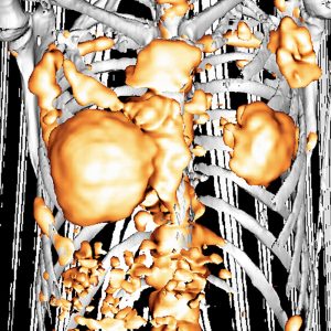 Beidseitiger Brustkrebs mit generalisierten Knochenmetastasen FDG-PET/CT