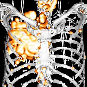 BroCa3D_oss_pulm_Meta