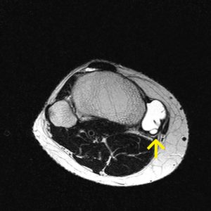 Bursitis des pes anserinus MRT-T2W-axial