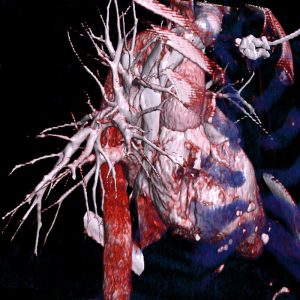 CTA Lungengefäße nach Lungenarterienembolie