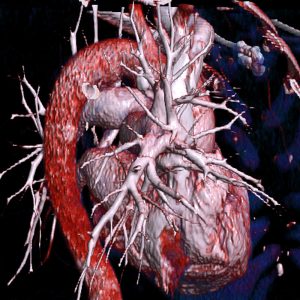 CTA der Lungengefäße nach Lungenarterienembolie