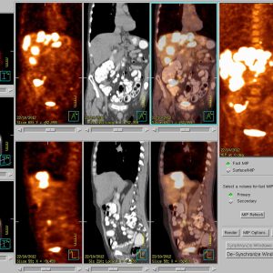 CUP Duenndarmcarcinom des Ileum mit Leber- und Lungenmetastasen FDG-PET/CT