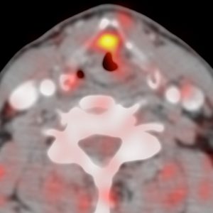 CUP Plattenepithelkarzinom Larynx FDG-PET/CT CUP Plattenepithelkarzinom Larynx FDG-PET/CT
