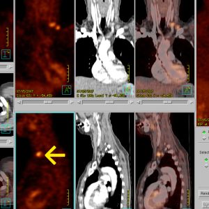 CUP Syndrom Urothelcarcinom Virchow Lymphknotenmetastase FDG-PET/CT