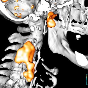 CUP Plattenepithelcarcinom Nasopharynx mit Lymphknotenmetastasen FDG-PET/CT