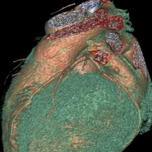 Cardio CT Left Anterior Descending LAD und Ramus -Circumflexus RCX-Coro-CT mit KM VR