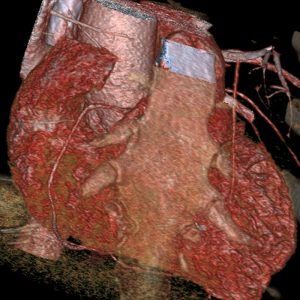 Cardio CT RCA