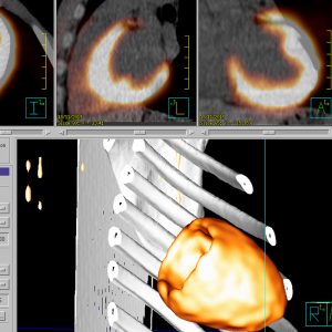 Cardio PET unauffällig FDG-PET/CT