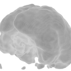 Cerebellärer Hypometabolismus PICA-Direktabgang FDG-PET-VR