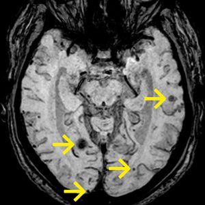Cerebrale Amyloidangiopathie SWI-MinIP