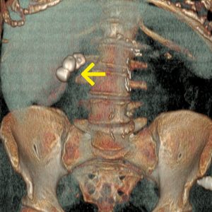 Cholezystolithiasis CT-VR