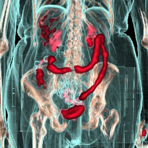 Colitis ulcerosa FDG-PET/CT-VR Colitis ulcerosa FDG-PET/CT-VR