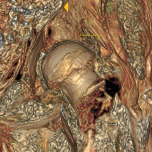 Coxarthrose li Knorpelschaden