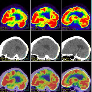 Demenz vom Alzheimertyp DAT FDG-PET/CT