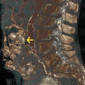Diffus grosszelliges Lymphom / verkalkter Rest nach Chemotherapie CT-VR