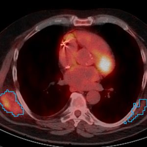Elastofibrom FDG-PET/CT