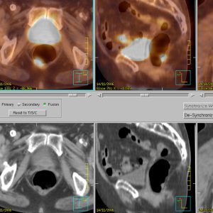 Entdifferenzierter Rektumpolyp FDG-PET/CT