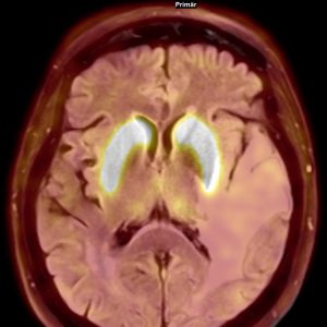 F-DOPA PET-MRT Normalbefund