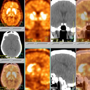 F-DOPA PET/CT Normalbefund