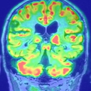 Florbetaben PET-MRT-Fusion positiver Befund