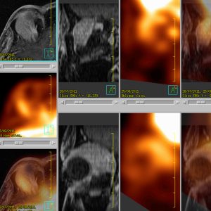 Follikuläres Non-Hodgkin-Lymphom der Glandula lacrimalis FDG-PET/CT Follikuläres Non-Hodgkin-Lymphom der Glandula lacrimalis FDG-PET/CT