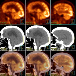 Frontotemporale Demenz M. Pick FDG-PET/CT