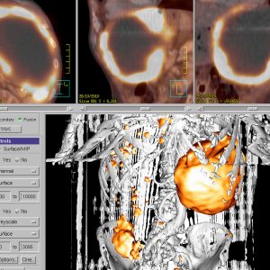 GIST Gastrointestinaler Stromatumor FDG-PET/CT