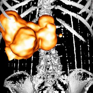 Gallenwegscarcinom FDG-PET/CT