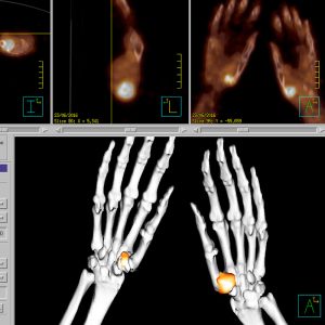 Gicht Rhizarthritis urica Podagra FDG-PET/CT