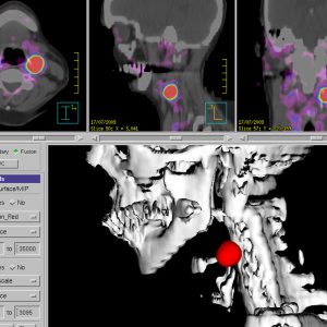 Glomus caroticum Tumor Ga68-DOTATOC-PET/CT
