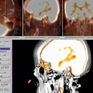 Glomus jugulare Tumor