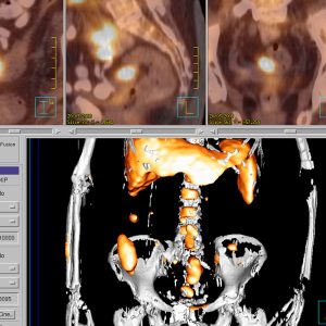 Granulomatoese Darmenzuendung-Va Tuberkulose FDG-PET/CT Granulomatoese Darmenzuendung-Va Tuberkulose FDG-PET/CT