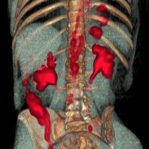 Großgefäßvaskulitis der Aorta FDG-PET/CT