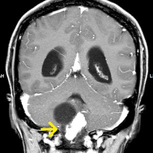 Haemangioblastom-cyst-and-mural-nodule-MRT-T1W-mit-KM-coronar