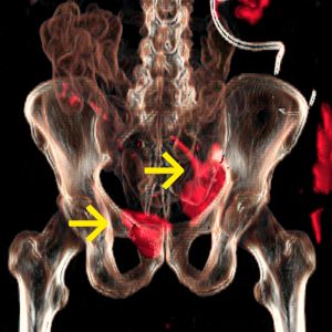 Harnblasenkarz viertes Rezidiv Lymphknoten li Schambbein rechts FDG-PET/CT