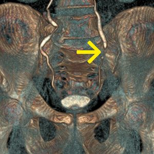 Harnleitertumor li CT-Urographie Mikrohaematurie Harnleitertumor li CT-Urographie Mikrohaematurie
