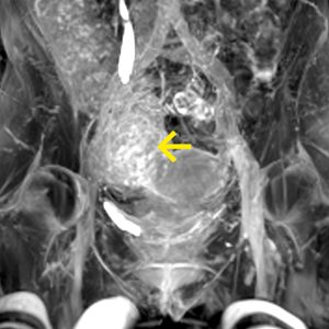 Harnstau re abszediende Appendicitis MR-Urographie