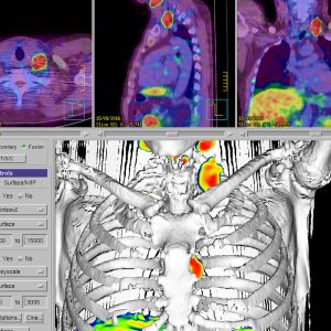 Hochrisikoprostatacarcinom Gleason 4+5=9 / iPSA 11 ng_ml Virchow LK Metastase Ga68- PSMA PET/CT