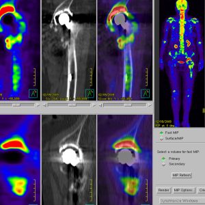 Hüft TEP Pfannenlockerung F18-Fluorid-PET/CT