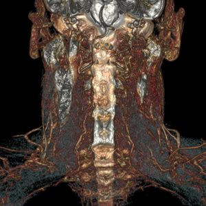 Hypopharynxcarcinom rechts Lymphknotenmetastasen MRT-Volumenrekonstruktion